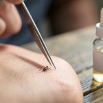Zbliżenie na pęsetę chwytającą kleszcza na skórze, obok stoi butelka z antyseptykiem